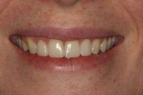 before and after traditional braces