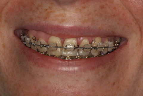 before and after traditional braces