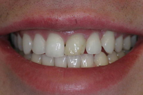 Before and After Cosmetic Treatment