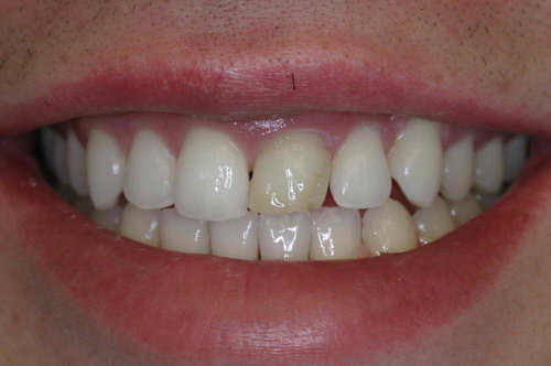 Front Tooth Match Before Image