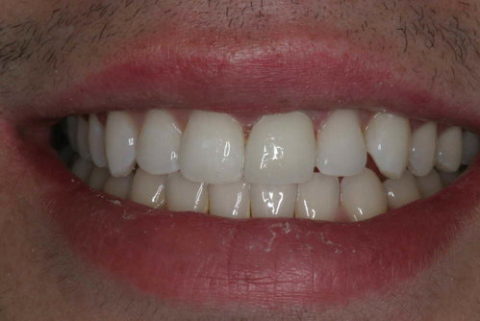 Before and After Cosmetic Treatment