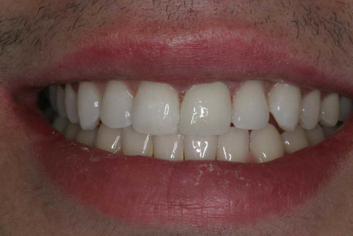Front Tooth Match After Image