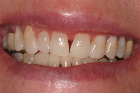 Before and After Teeth Straightening