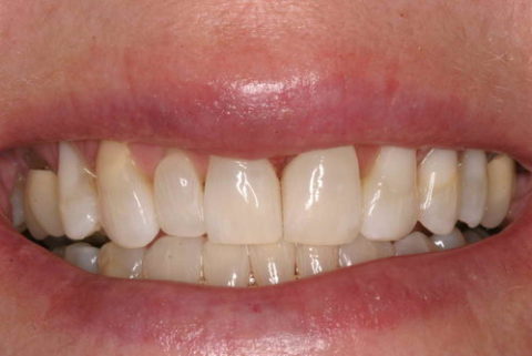 Before and After Teeth Straightening
