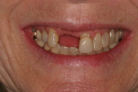 before and after crowns and bridge