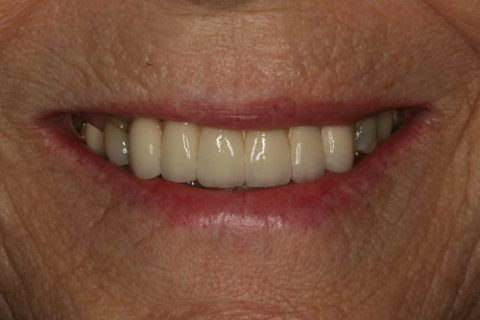 before and after crowns and bridge