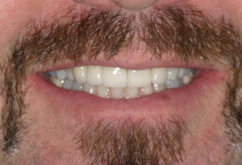 smile before and after cosmetic treatment