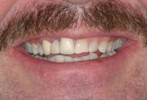 smile before and after cosmetic treatment