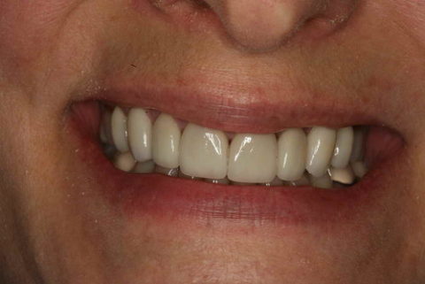 Photos of before and after cosmetic treatment