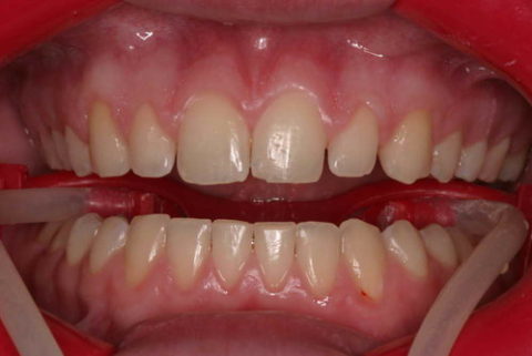 smile before and after cosmetic treatment