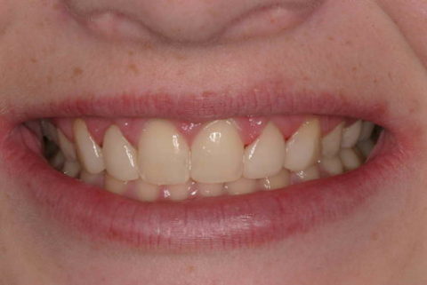 smile before and after cosmetic treatment