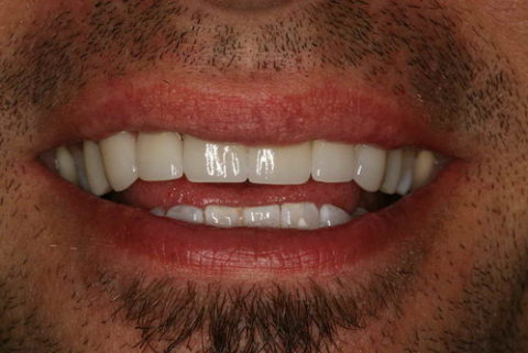 before and after images of dental crowns