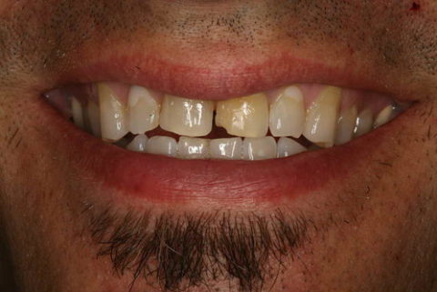 before and after images of dental crowns