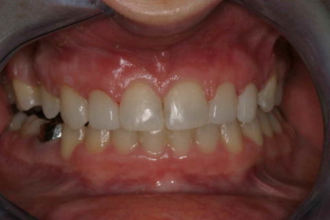 Before and After Fillings