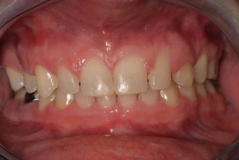 Before and After Fillings