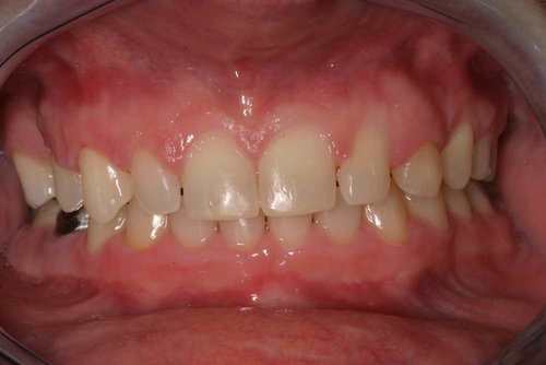 Tooth Whitening Before Image