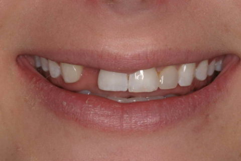 Before and After an Implant
