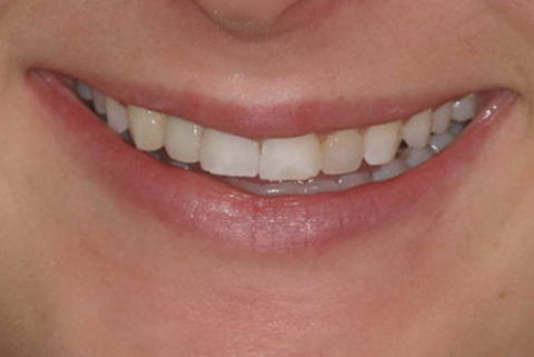 Before and After an Implant