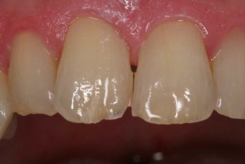 Before and After Dental Treatment at Saratoga Dentistry