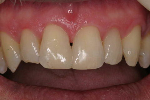 Before and After Dental Treatment at Saratoga Dentistry