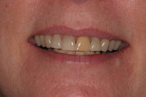 Before and After Veneers