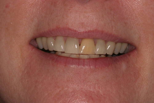 Patient5 Front Tooth Crn Match Before