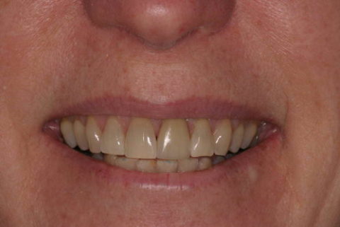 Before and After Veneers