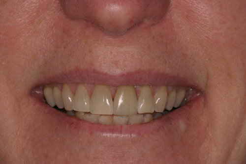 Patient5 Front Tooth Crn Match After