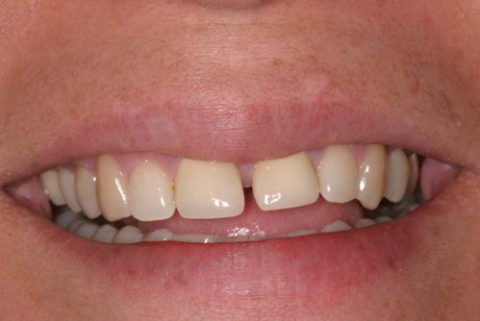 Gaps between teeth removed