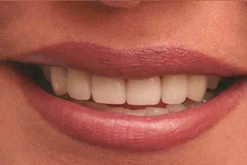 Gaps between teeth removed