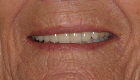 Cosmetic Dentistry Treatment before and after pictures