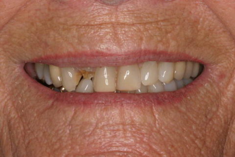 Cosmetic Dentistry Treatment before and after pictures