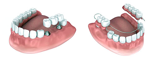 Dental Bridges