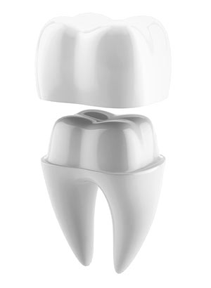 Dental Crowns