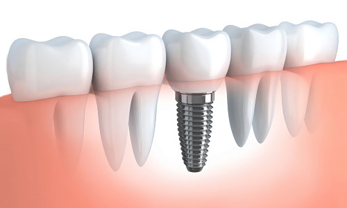 Dental Implants