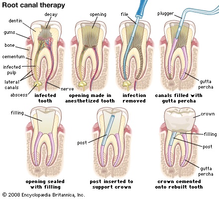 Root Canal Therapy