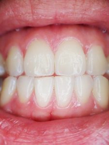 Gums and Teeth