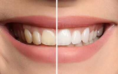 Should I choose teeth whitening, porcelain veneers, or a combination?
