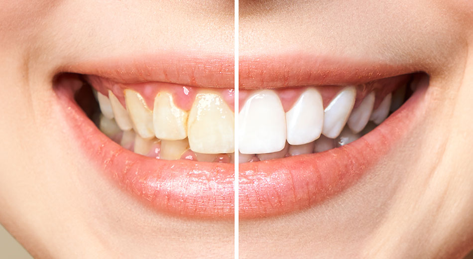 What are the advantages of teeth whitening at the dentist’s office?