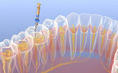 Answers to your top questions about Root Canals