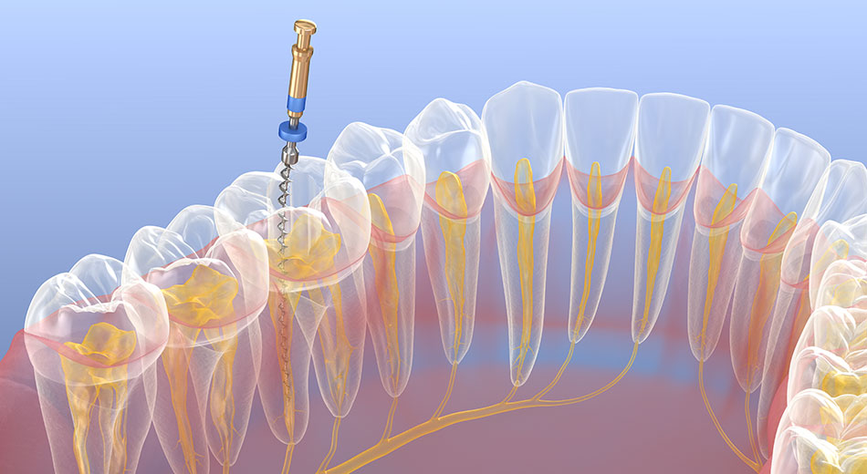 Answers to your top questions about Root Canals