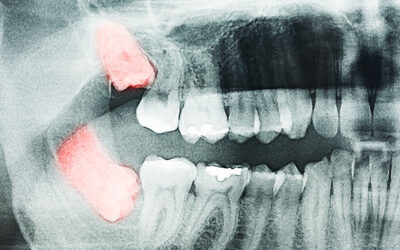 Top Reasons for Extracting Impacted or Problematic Wisdom Teeth