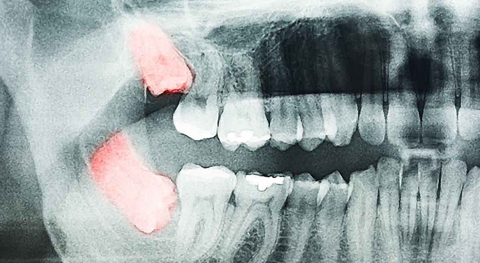 Top Reasons for Extracting Impacted or Problematic Wisdom Teeth