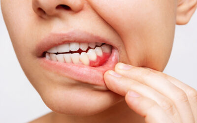 Beyond Bleeding Gums: Understanding the Early Stages of Periodontal Disease