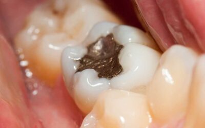 Choosing the Right Dental Filling for Your Smile